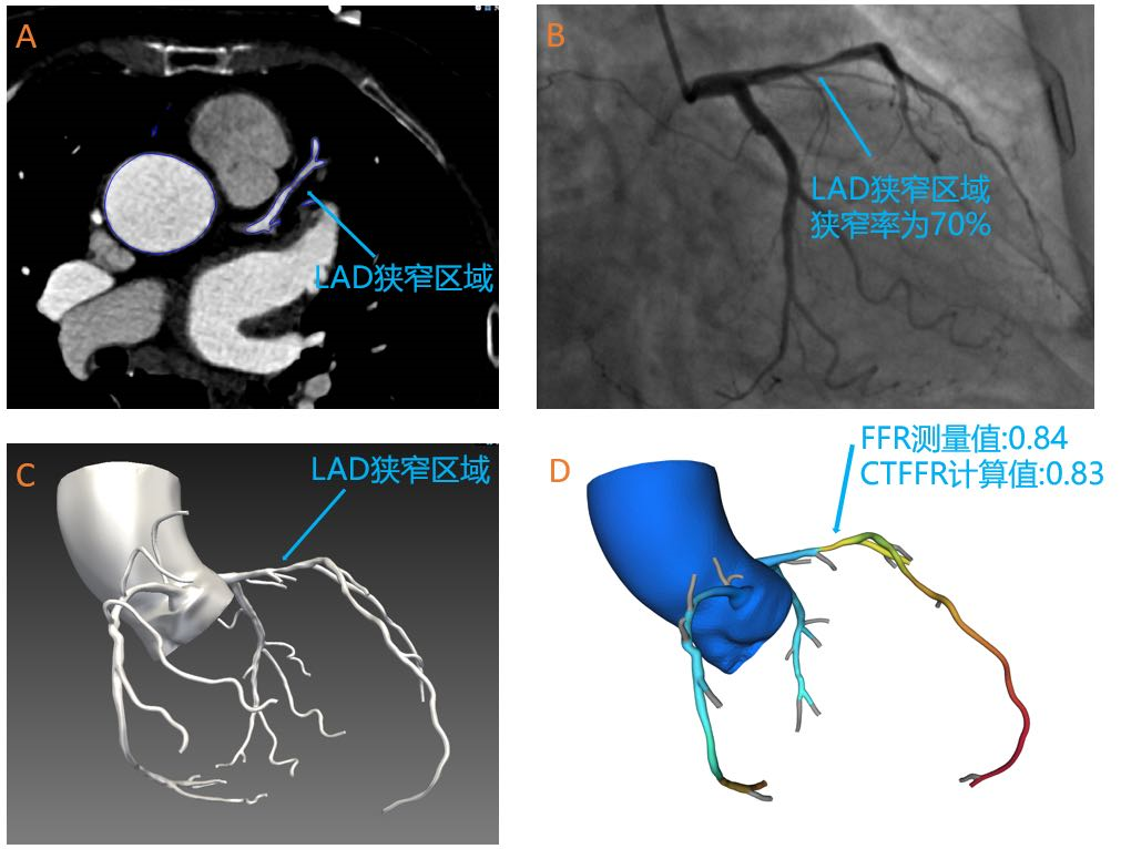 奧泰康助力睿心醫(yī)療&mdash;《冠狀動(dòng)脈供血功能（CT-FFR）評(píng)估軟件》產(chǎn)品完成創(chuàng)新審評(píng)及臨床試驗(yàn)