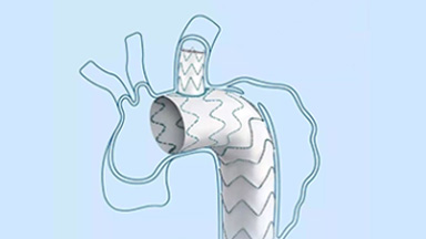 一體式人工血管術(shù)中支架系統(tǒng)（華脈泰科）